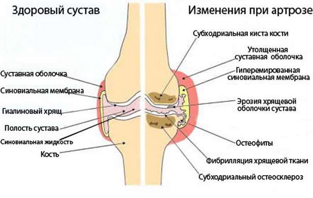 причины артроза коленного сустава